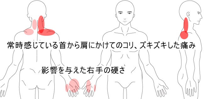 肩こり 首の痛みの症例 札幌市白石区のととのえ鍼灸院 鍼専門 過敏性腸症候群 Ibs 機能性ディスペプシア 腰痛はととのえ鍼灸院