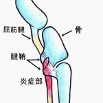 ばね指の意外な事実！！の詳細へ