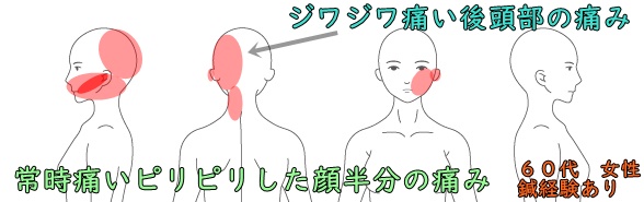 頭痛 片頭痛 緊張型頭痛 群発性頭痛 の症例 札幌市白石区のととのえ鍼灸院 鍼専門 過敏性腸症候群 Ibs 機能性ディスペプシア 腰痛はととのえ鍼灸院