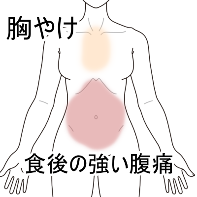 過敏性腸症候群、IBS、腹痛、ガスだまり、ガス漏れ、便秘、札幌、白石区、鍼灸